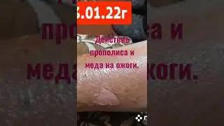 действие прополиса и меда на ожоги