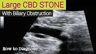 Large CBD Stone | Ultrasound | Biliary Obstruction