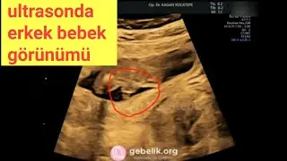 15+5 haftada ultrasonda erkek bebeğin bacak arasından cinsiyeti görülüyor. Bu durumda yanılma olmaz.