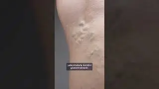 Köpüklü Varis Tedavisi