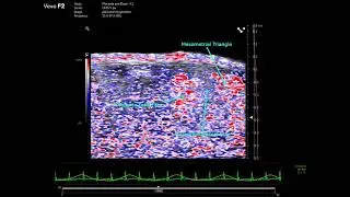 Placental Oxygen Saturation