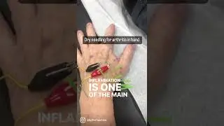 Dry Needling With Estim for arthritis in the hand