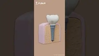 3D printed dental implant model. Perfect for education and design showcase #flsunprinter #dental