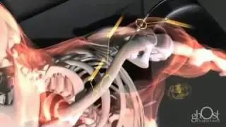 bone fracture repair animation Medical Animation Demo Reel