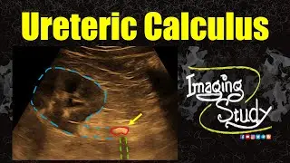Ureteric Calculus || Ultrasound || Case 352
