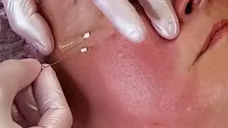 Мезонити для коррекции мешков под глазами.