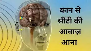 कान से सीटी की आवाज़ क्यो आती हैं ? whistling sound in the ears