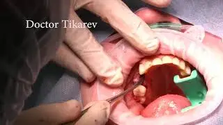 Straumann  guide surgery Установка имплантатов Straumann BLT