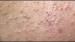 Acne treatment under the skin (P.2) #HoangMySpa117