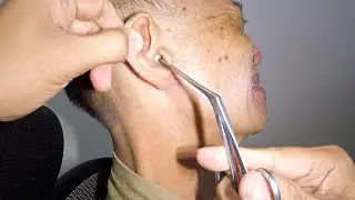 Cotton Stuck and Trapped in Man's Ear | This is How It's Removed