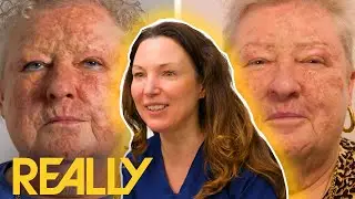 Unbelievable Face Transformation Gives Woman A Huge Confidence Boost! | The Bad Skin Clinic