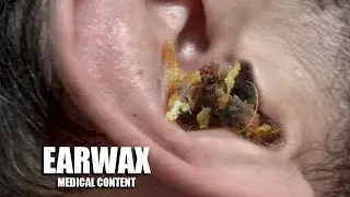 Earwax Removal Tools!  Tonsil Stone Removal Tools