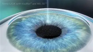 Technique chirurgie FEMTO LASIK