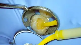 Post root canal treatment CORE BUILD UP