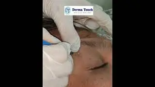 Skin tags around eyes