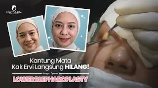 KANTUNG MATA KAK ERVI LANGSUNG HILANG!😱 | #LowerBlepharoplasty