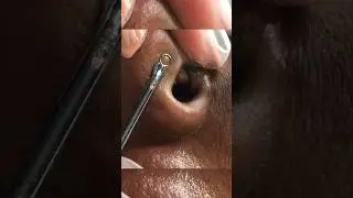 More satisfying extractions | archives | #omg #extractions