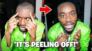 My Hairline is peeling off...