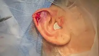 Correction of Stahl's Ear
