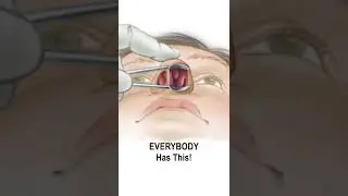 Nasal Obstruction Due to Turbinate Hypertrophy 