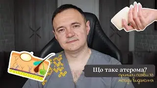 Атерома. Як її лікувати? Чи є атерома раком?