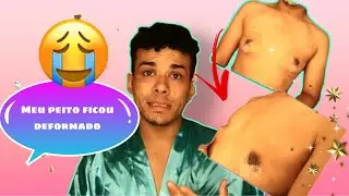 Fiz cirurgia de ginecomastia e olha como ficou meu peito 💔