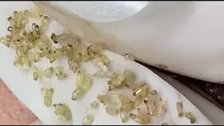 Blackheads on the girl's peeling skin (Tram P3) 