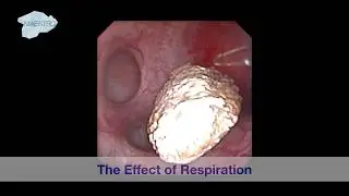 The Effect of Respiration