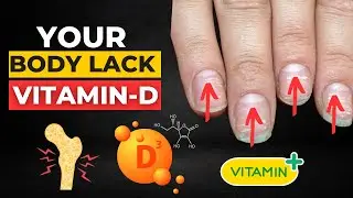 Top 8 Vitamin D Deficiency Symptoms | Low Vitamin D Symptoms | Vitamin D Depression | Low Vitamin D