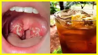 como curar la amigdalitis cronica de forma natural