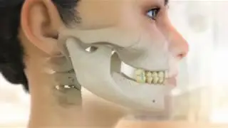 Molen Orthodontics' Herbst Technique
