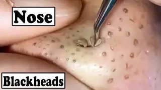 Best Removal Of Blackheads On The Nose