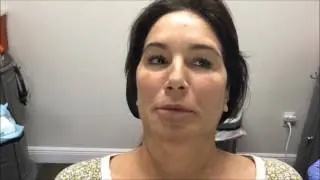 Lip Restoration with Filler & PDO Threads with Before and After2