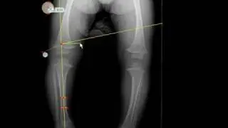 TraumaCad - Metaphyseal-Diaphyseal Angle