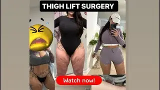 My thigh lift surgery PART 1