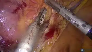 Laparoscopic CME and D3 lymphadenectomy for right-sided colon cancer