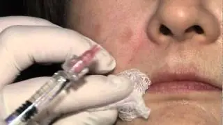 Liquid Facelift in Los Angeles