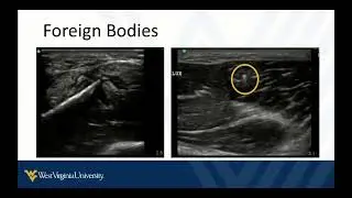 POCUS in Skin and Soft Tissue Infections 2 - Other Findings