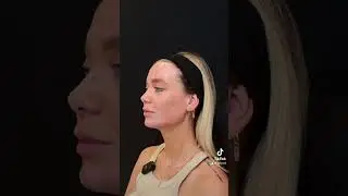 JAWLINE CONTOURING mit HYALURON 💉 vorher/nachher 