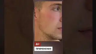 Результат Ксиноксина для роста бороды