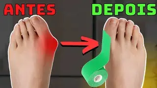 HOW TO CORRECT A BUNION WITH A FUNCTIONAL BANDAGE