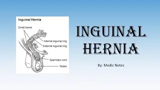 Inguinal hernia - direct vs indirect, anatomy of inguinal canal, deep ring occlusion test, surgery