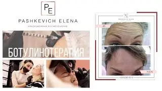 Ботокс. Ботулинотерапия. Ботокс для лица. Как убрать морщины. Фото до/после