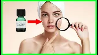 How To Use Tea Tree Oil To Treat Acne Naturally? - Get Rid Of Your Acne Forever!