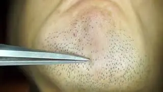 Hair removal asmr pull out with Tweezers  Satisfying pull out beard 10min 202408b