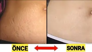 Karındaki çatlaklara son %100  ve kilolu kişilerde oluşan çatlaklara doğal karışım ile son buluyor