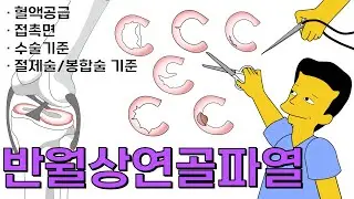 반월상연골파열 시즌4-2 : 혈액공급, 접촉면, 수술기준, 절제술봉합술기준