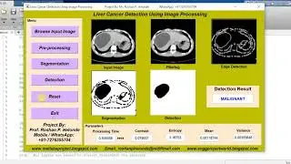 LIVER CANCER DETECTION Using Image Processing Matlab Project Source Code