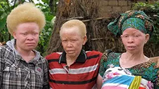 Born Too White: What It's Like To Have Albinism in Africa | BORN DIFFERENT