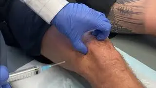 KNEE- Intra-articular injection of Local Anaesthetic and Steroid